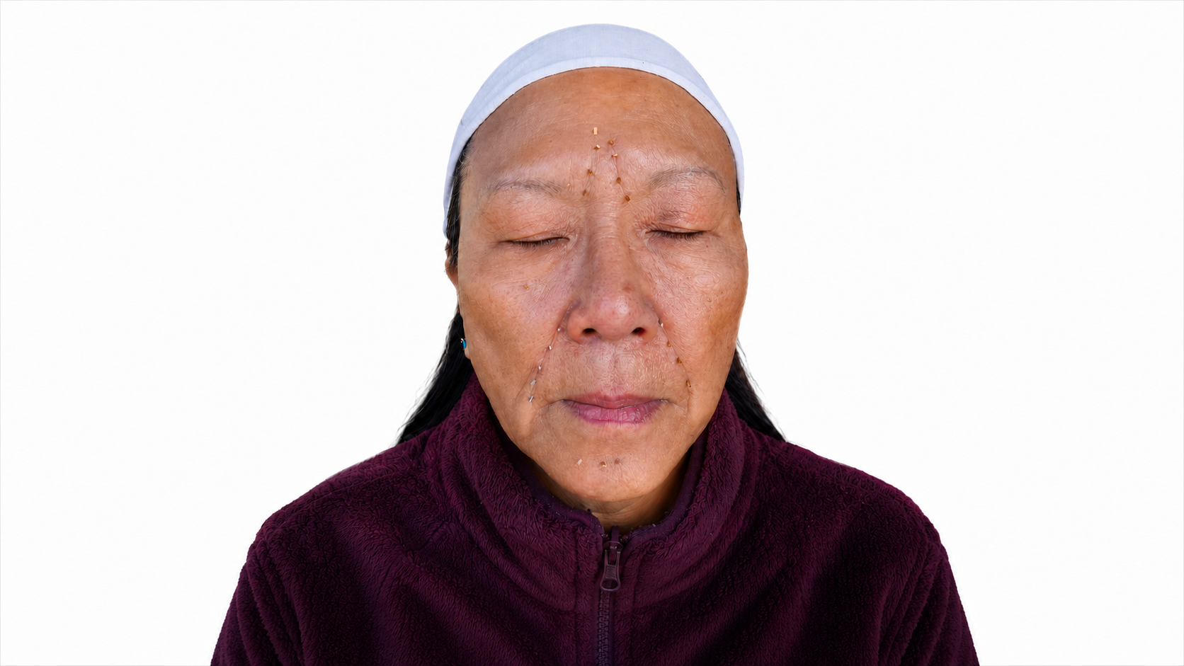 Cosmetic Microneedling Facial