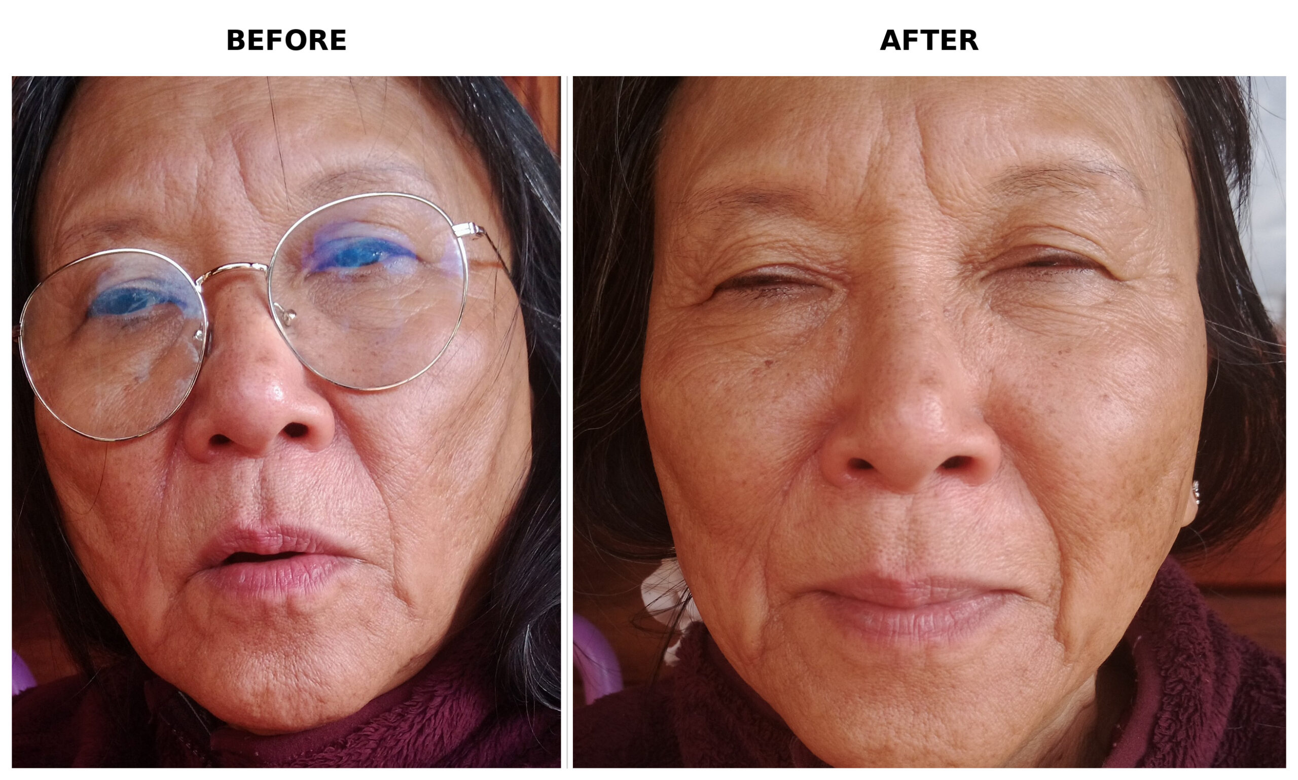 Microneedling before and after
